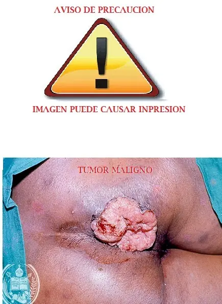 cancer