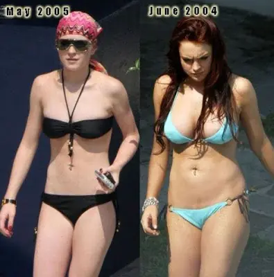 anorexia