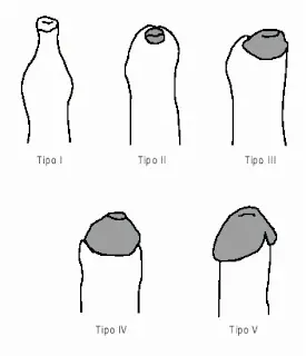 Sobre fimosis, esmegma y otras porquerías.