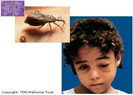 Enfermedad de Chagas, Una Realidad Silenciosa