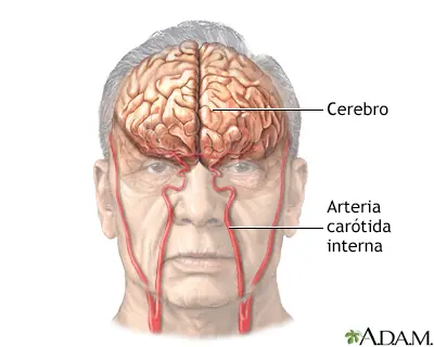 Accidente cerebrovascular