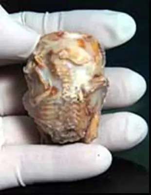 Lithopedion (Bebés de piedra)