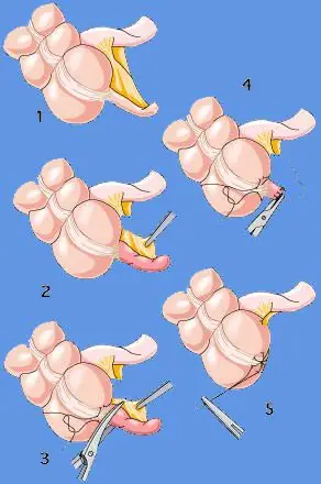 apendicitis