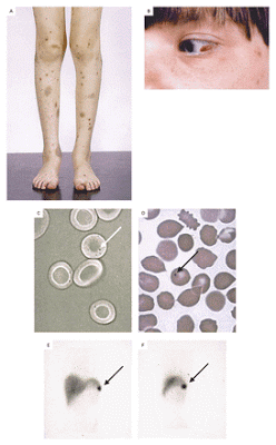 Enfermedad rara: Sindrome De Evans