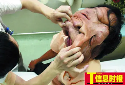 Hombre Elefante (elefantiasis) ayudemos al TOP