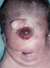 Hombre Elefante (elefantiasis) ayudemos al TOP