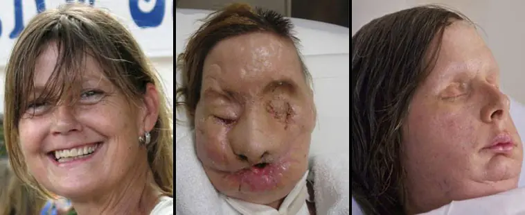 reconstruccion de rostro