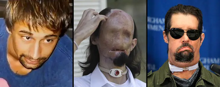 transplantes de rostro