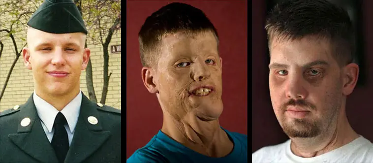 transplantes de cara