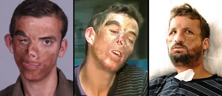 Exitosos transplantes de rostros (fotos + info) Megapost