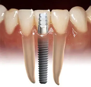¡Si queres saber de implantes dentales entra acá!