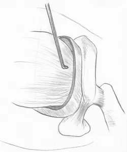 lesiones