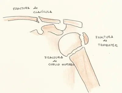 Lesiones y Tratamientos ( hombro y tobillo)