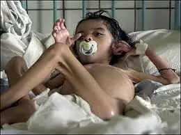 Desnutricion en Argentina