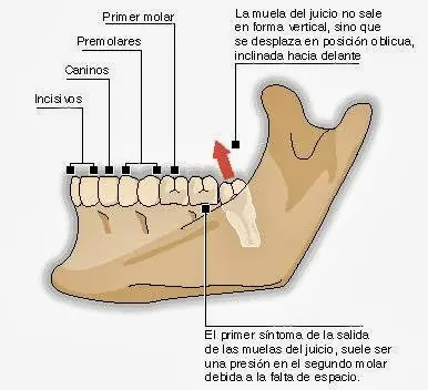 ¿Para qué sirve la muela del juicio? y otras preguntas