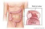 Glucemia elevada se relaciona con el cáncer colorrectal.