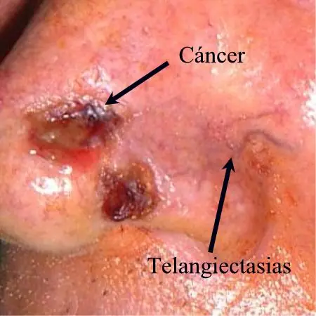 cancer
