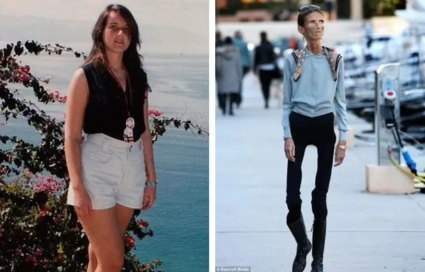 anorexia