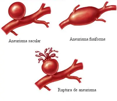 Aneurisma en el cerebro