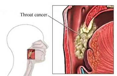 Cáncer de garganta