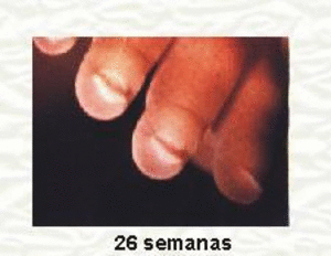 Embarazo