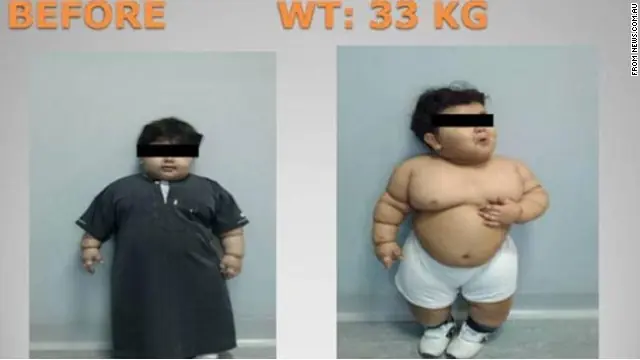 Someten a un niño de dos años a una cirugía para bajar de