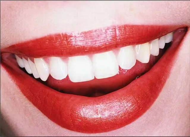 Como Cuidar Tus Dientes [Post-Completo]