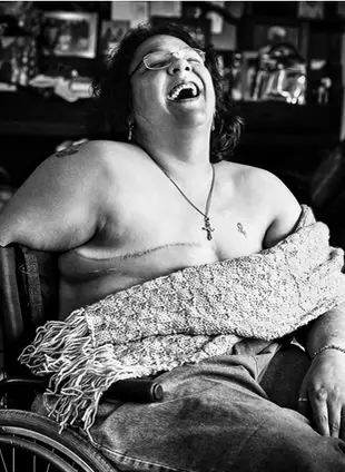 La vida después de una mastectomía