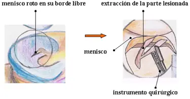 rotura de meniscos, yo me los rompi :(