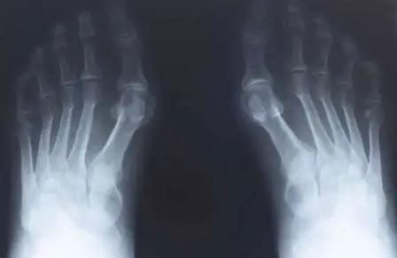 neuropatía