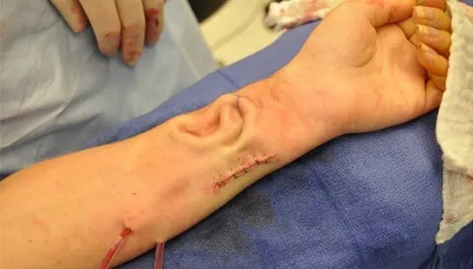 Le implantan una oreja “cultivada” en su propio brazo