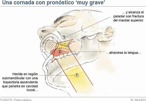 Cuerno de toro atriaviesa mandibula de Torero