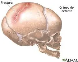 fracturas