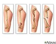 fracturas