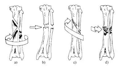 Breve informe sobre Fracturas