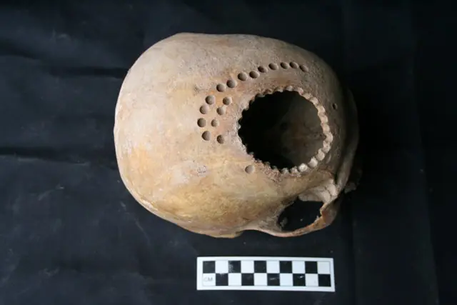 trepanaciones