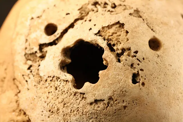 Así eran los ‘neurocirujanos’ de hace 1.000 años