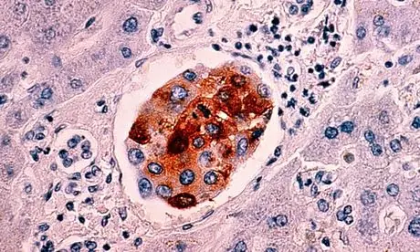 Se espera que los casos de cáncer aumenten un 70%