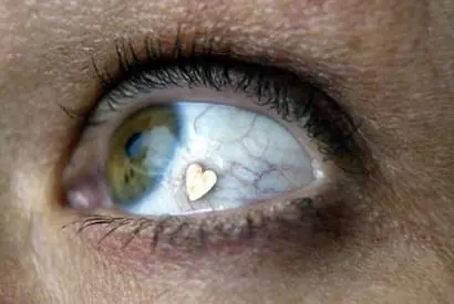 implantes