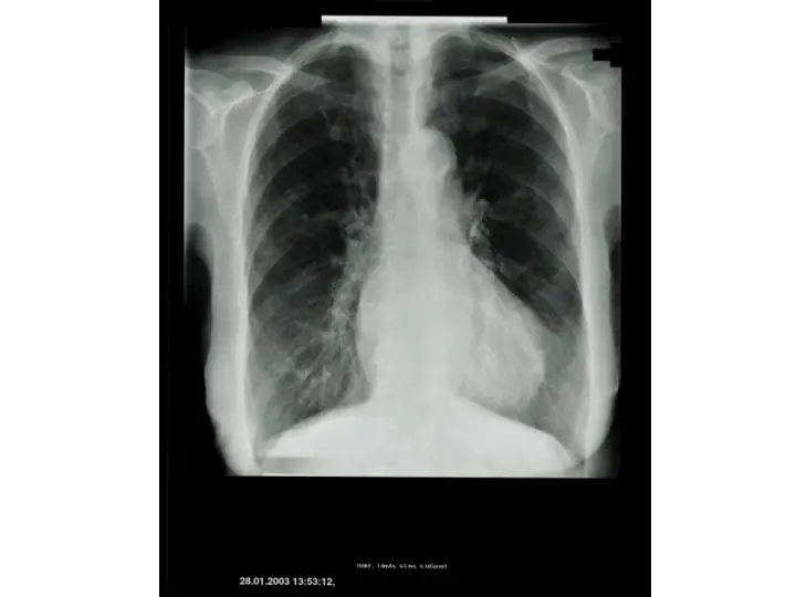 Los pulmones y la bilirrubina