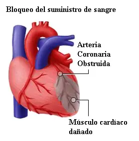 Infarto de miocardio