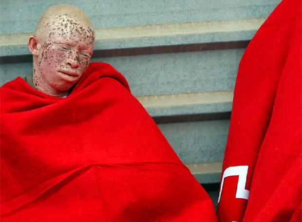 Albino negro consigue asilo en españa
