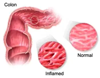 irritación