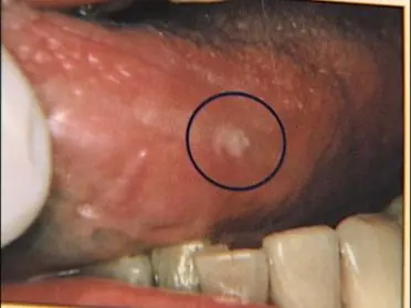 Cáncer Oral(Cancer En La Boca)