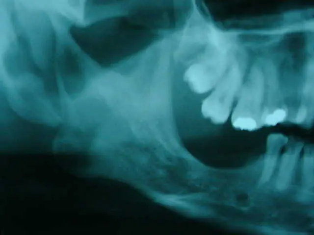 mucosa