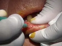 Enfermedades Patologías Bucales [Megapost]
