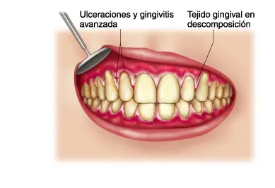mucosa