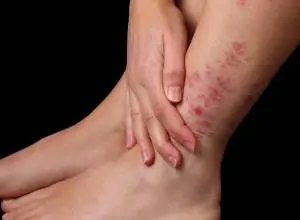 Tratamiento multidisciplinario, clave contra la psoriasis