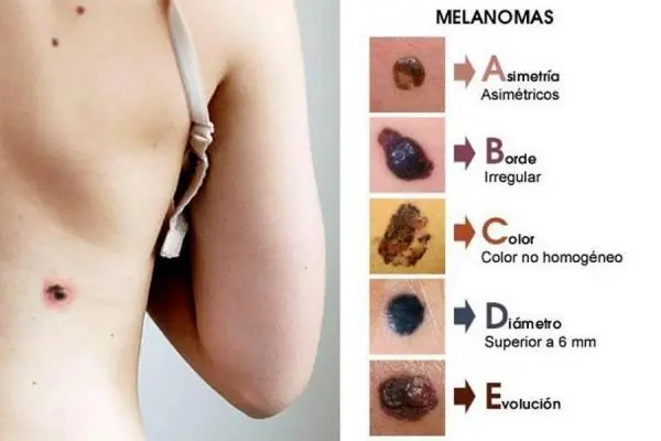 Piel, lunares: cuando ir al medico