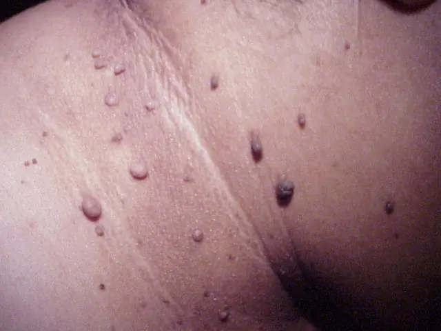 melanoma